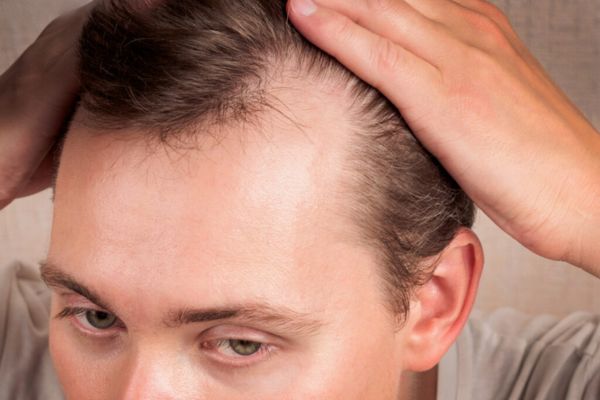 PRP Alopecia